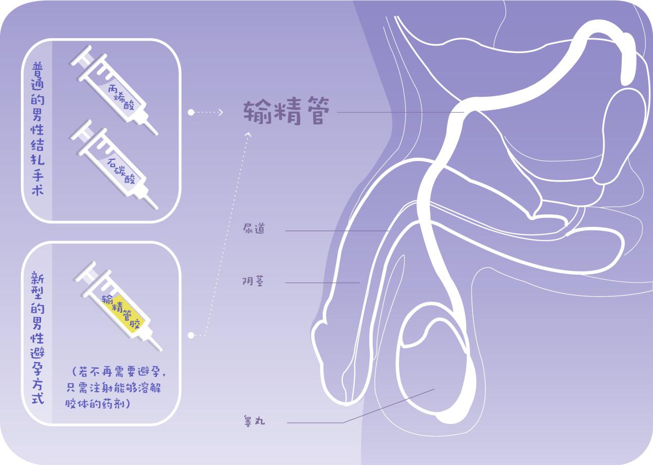 正文  而今,"输精管胶"的出现为男性避孕提供了新的可能.