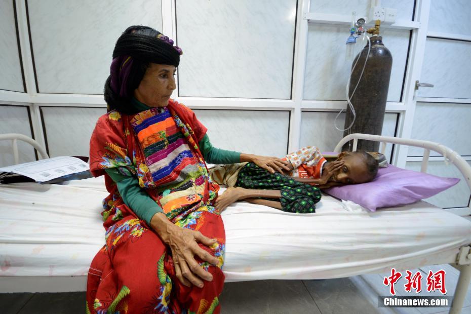 也门18岁女孩因营养不良形销骨立状如骷髅